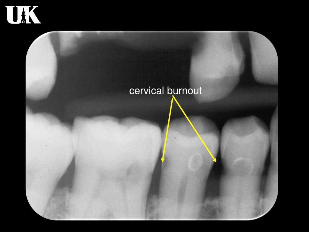 What Is Cervical Burnout Radiograph at Sheryl Delacruz blog